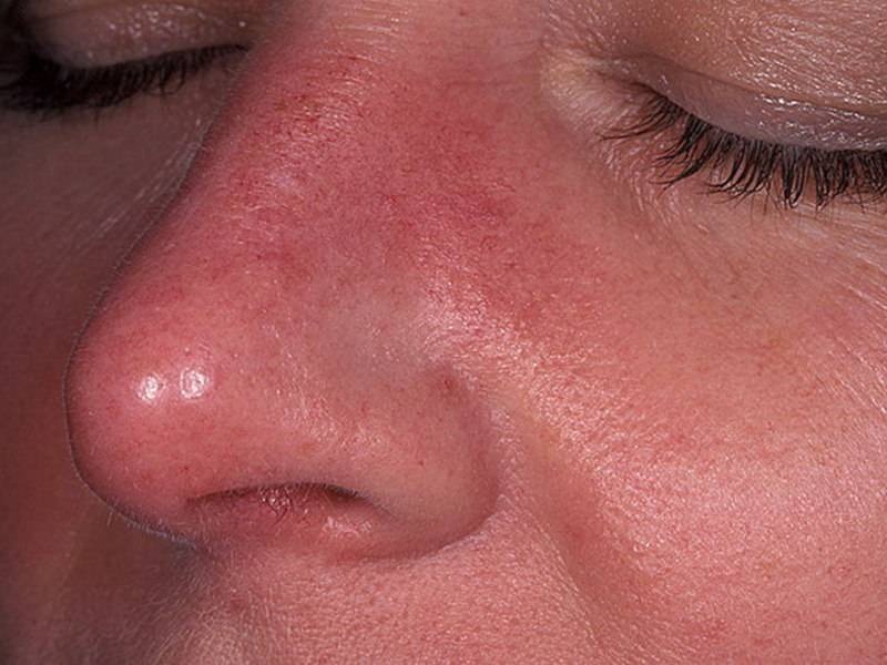 Рожисте запалення обличчя [рожа] – підступність патології, її лікування